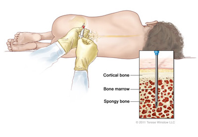 Bone Marrow Aspirate