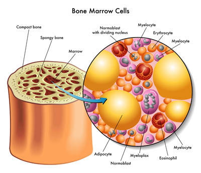 bone marrow transplant cells stem blood cell biopsy bones bmt where