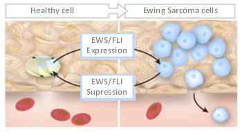 Ewing Sarcoma Model