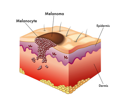 Symptoms and Pictures of Stage 4 Melanoma - Healthline