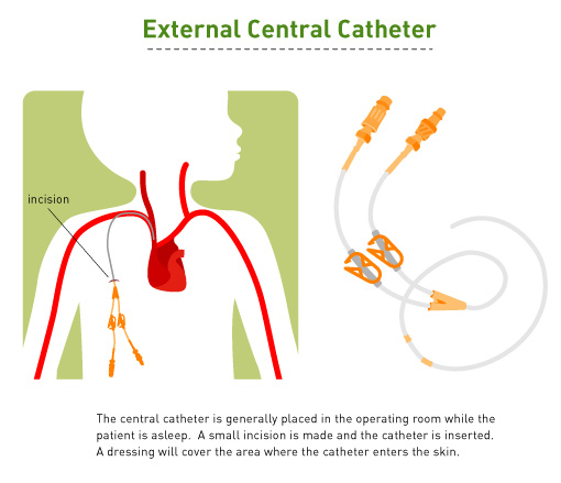 External Central Catheter